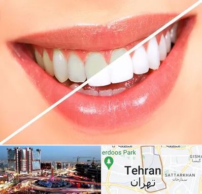 بلیچینگ دندان در صادقیه 