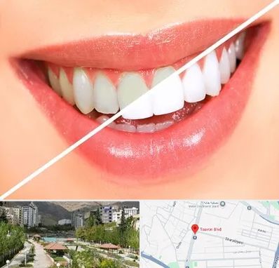 بلیچینگ دندان در بلوار تعاون