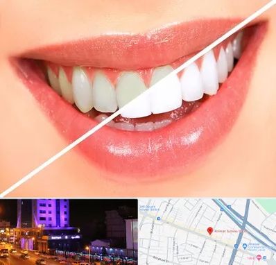 بلیچینگ دندان در آبرسان تبریز