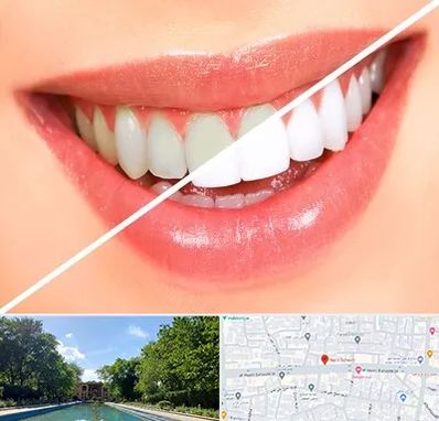 بلیچینگ دندان در هشت بهشت اصفهان