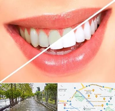 بلیچینگ دندان در خیابان ارم شیراز