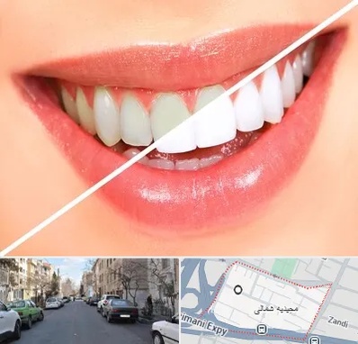 بلیچینگ دندان در مجیدیه شمالی