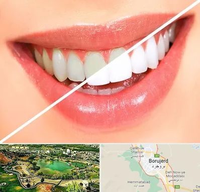 بلیچینگ دندان در بروجرد