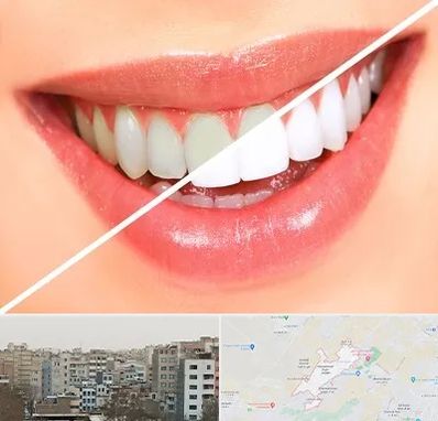 بلیچینگ دندان در محمد شهر کرج