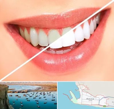 بلیچینگ دندان در چابهار