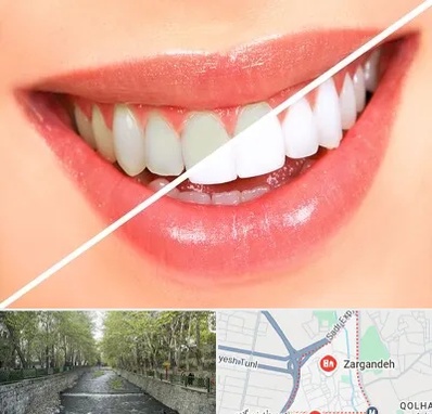 بلیچینگ دندان در زرگنده