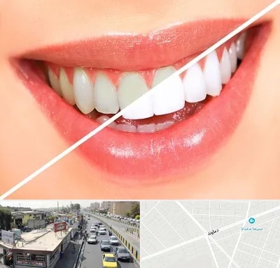 بلیچینگ دندان در خیابان دماوند