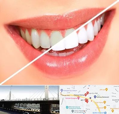 بلیچینگ دندان در پارک وی 