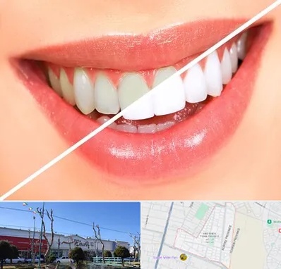 بلیچینگ دندان در فاز دو اندیشه