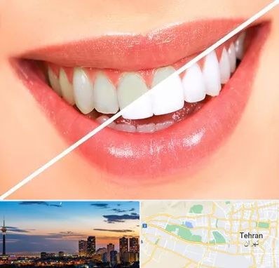 بلیچینگ دندان در غرب تهران 