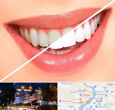 بلیچینگ دندان در کیانپارس اهواز