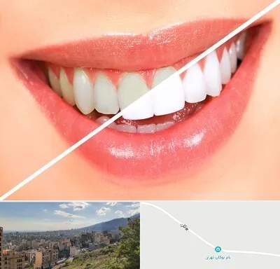 بلیچینگ دندان در بوکان تهران