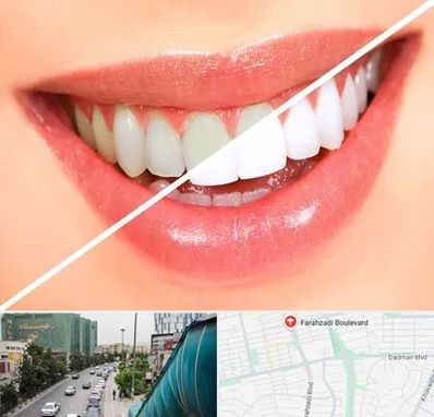 بلیچینگ دندان در بلوار فرحزادی