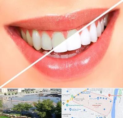 بلیچینگ دندان در گلستان اهواز