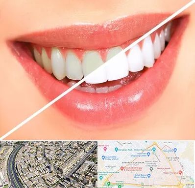 بلیچینگ دندان در شهرک غرب مشهد