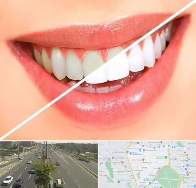 بلیچینگ دندان در منطقه 17 تهران