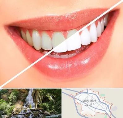 بلیچینگ دندان در الیگودرز