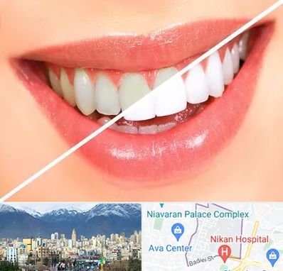 بلیچینگ دندان در آجودانیه 