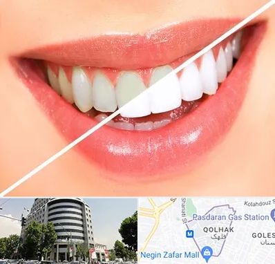 بلیچینگ دندان در قلهک 