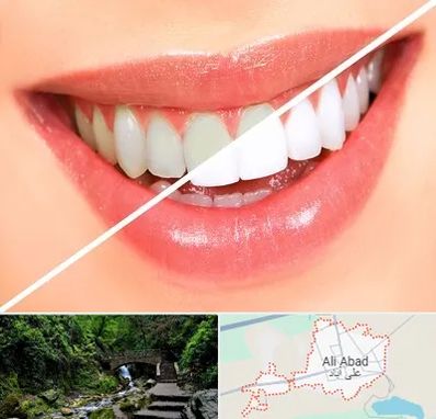 بلیچینگ دندان در علی آباد کتول