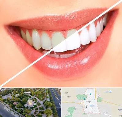 بلیچینگ دندان در کاشمر