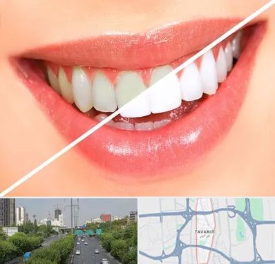 بلیچینگ دندان در توانیر