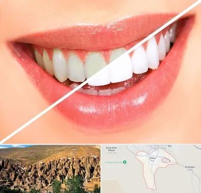 بلیچینگ دندان در اسکو