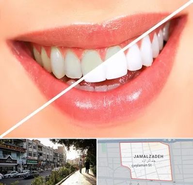 بلیچینگ دندان در خیابان جمالزاده