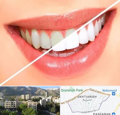 بلیچینگ دندان در اختیاریه 