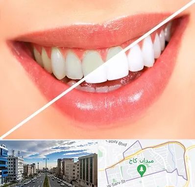 بلیچینگ دندان در سعادت آباد 