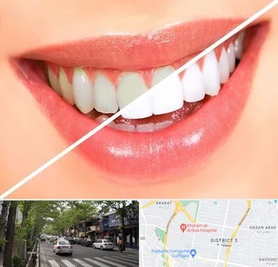 بلیچینگ دندان در ظفر 