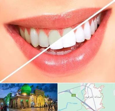 بلیچینگ دندان در آستانه اشرفیه