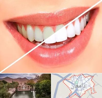 بلیچینگ دندان در دامغان