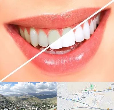 بلیچینگ دندان در رودهن