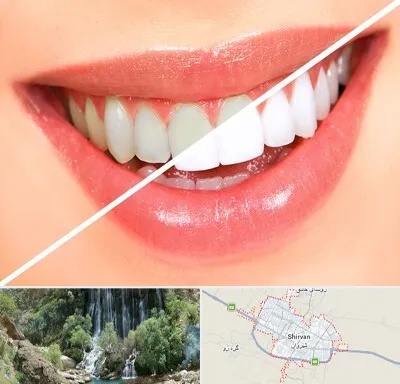 بلیچینگ دندان در شیروان
