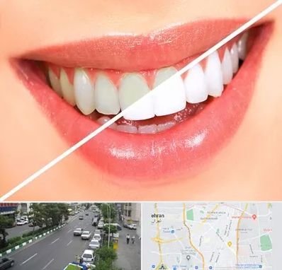 بلیچینگ دندان در ستارخان 