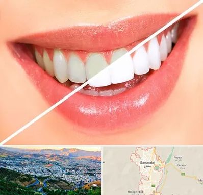 بلیچینگ دندان در سنندج
