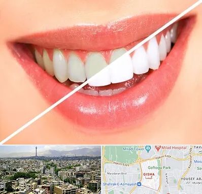بلیچینگ دندان در گیشا 