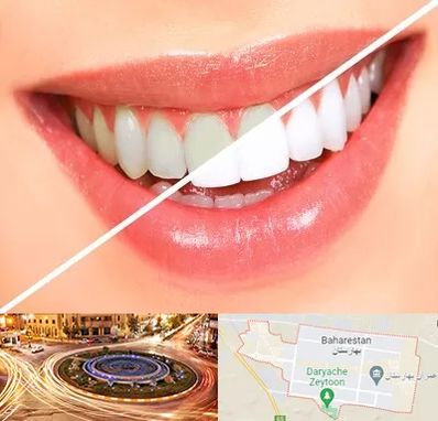 بلیچینگ دندان در بهارستان