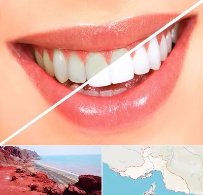 بلیچینگ دندان در هرمزگان