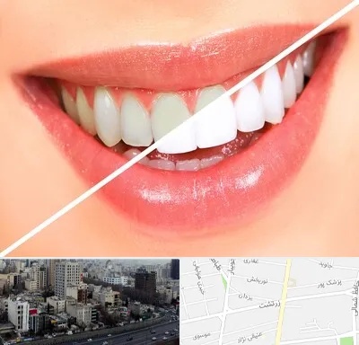 بلیچینگ دندان در زرتشت