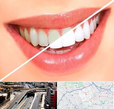 بلیچینگ دندان در ستارخان شیراز