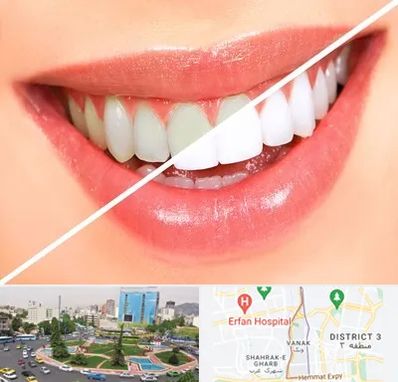 بلیچینگ دندان در ونک 