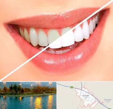 بلیچینگ دندان در قروه