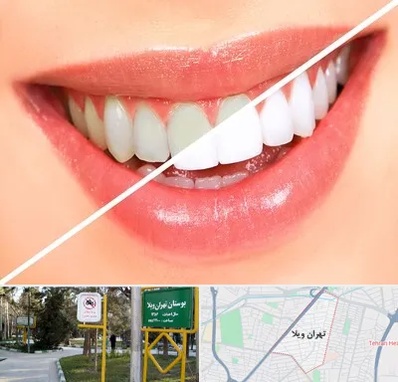 بلیچینگ دندان در تهران ویلا