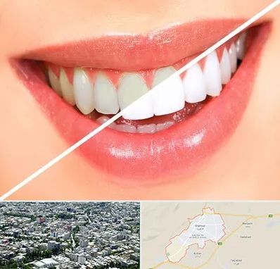بلیچینگ دندان در شاهرود
