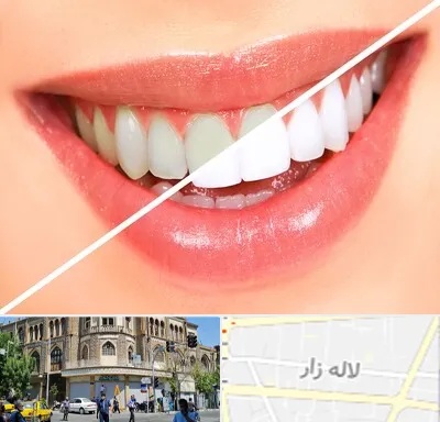 بلیچینگ دندان در لاله زار