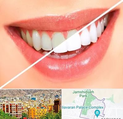 بلیچینگ دندان در نیاوران 