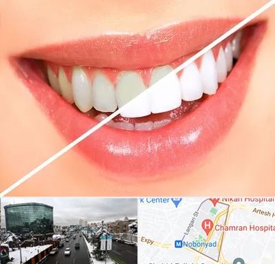 بلیچینگ دندان در اقدسیه 