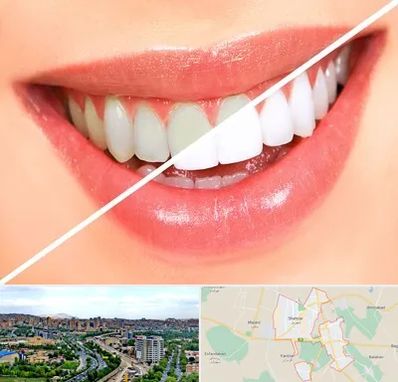 بلیچینگ دندان در شهریار